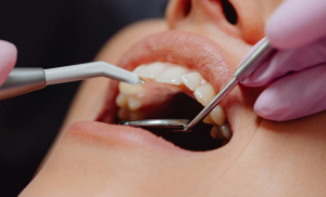 Korony na implantach – trwałe i estetyczne uzupełnienie braków zębowych