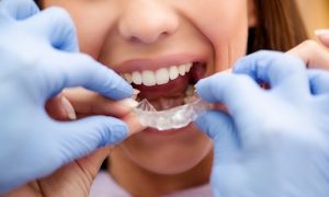 Fakty odnośnie prostowania zębów