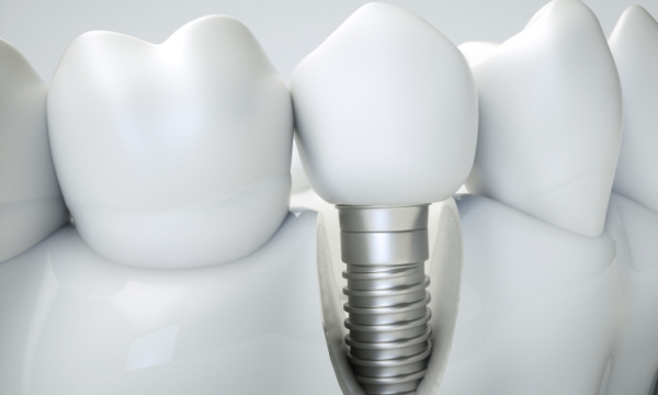 Dlaczego implanty zębowe są tak często stosowane w celu odbudowy uzębienia?